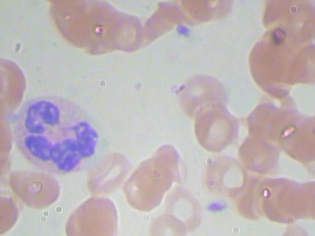 Peripheral blood smear field with red cells and a segmented neutrophil