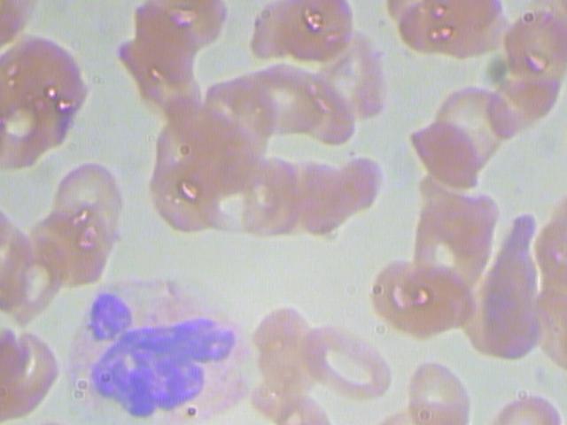 Peripheral blood smear field with red cells and a segmented neutrophil