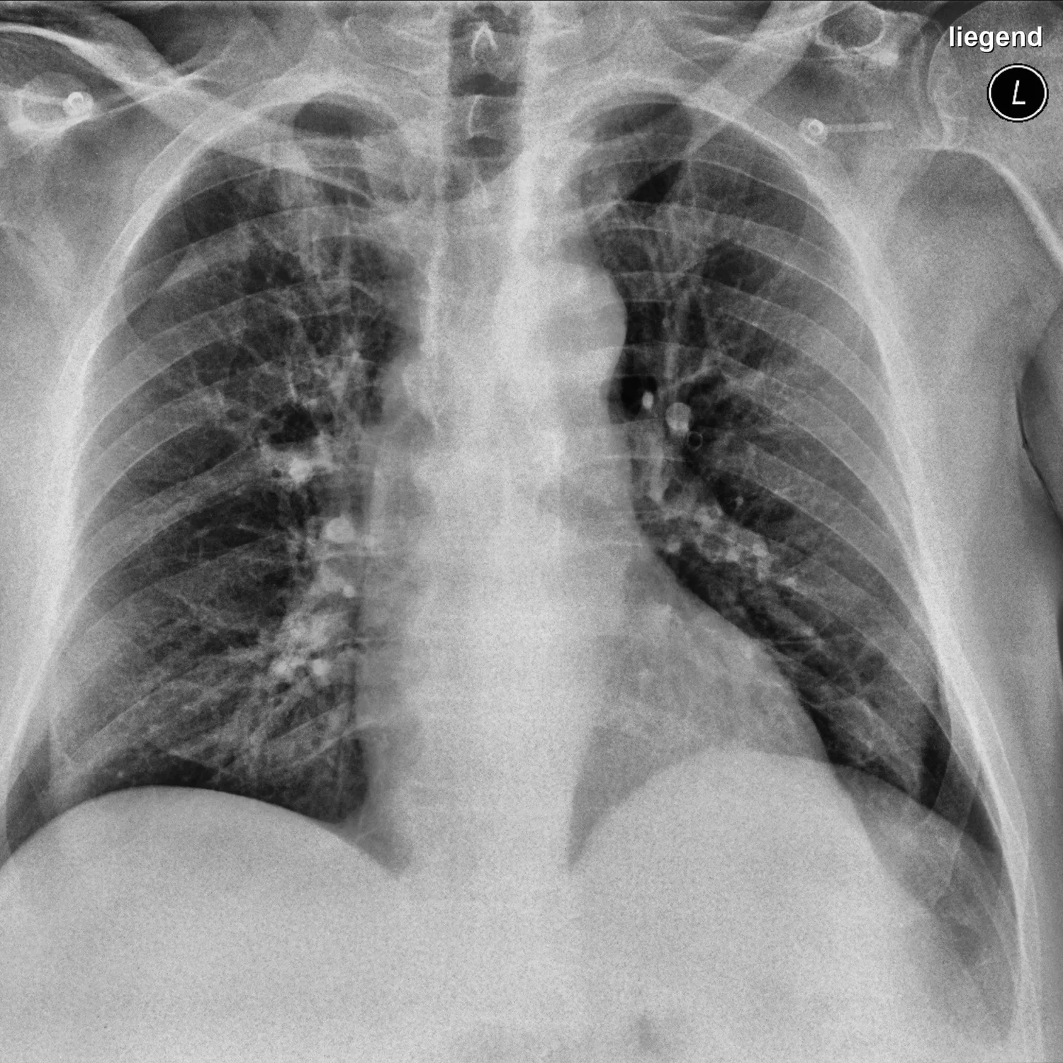 Chest radiograph showing patchy bilateral airspace opacities of viral pneumonia