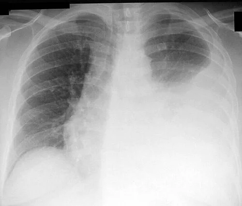 Frontal chest radiograph showing a large left pleural effusion with a meniscus