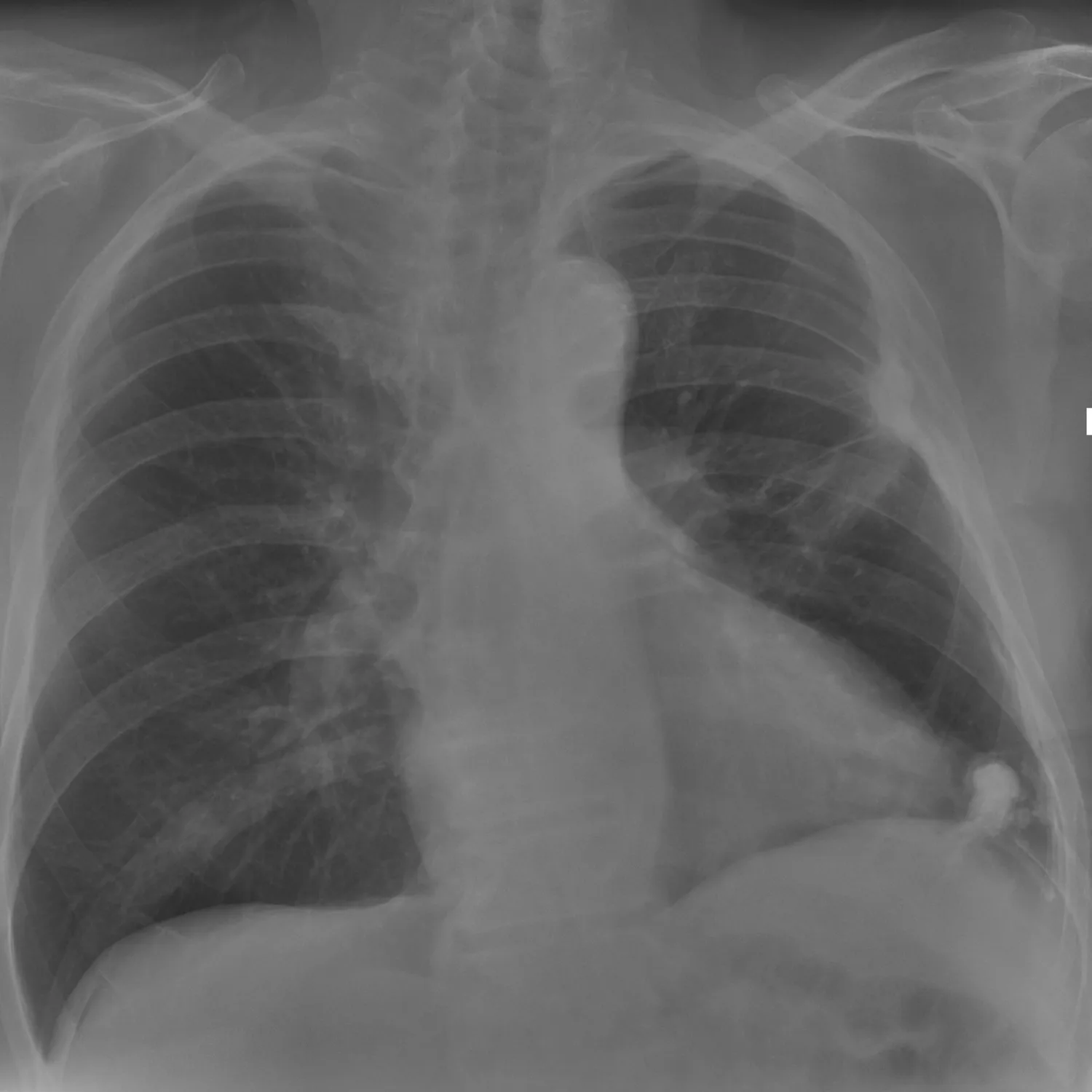 Frontal chest radiograph in viral pneumonia