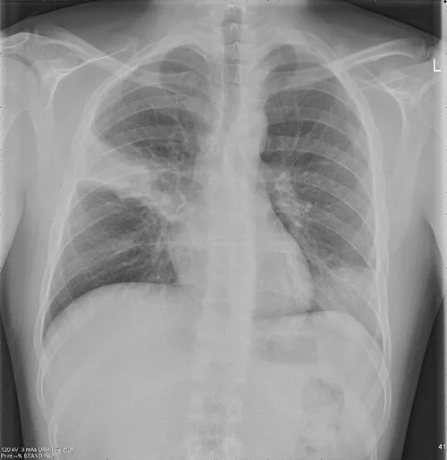 Frontal chest radiograph with dense consolidation at presentation of community acquired pneumonia