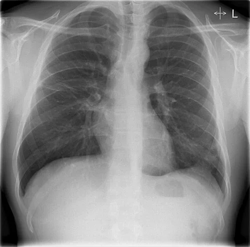 Frontal chest radiograph of the same patient after antibiotic treatment, consolidation largely cleared