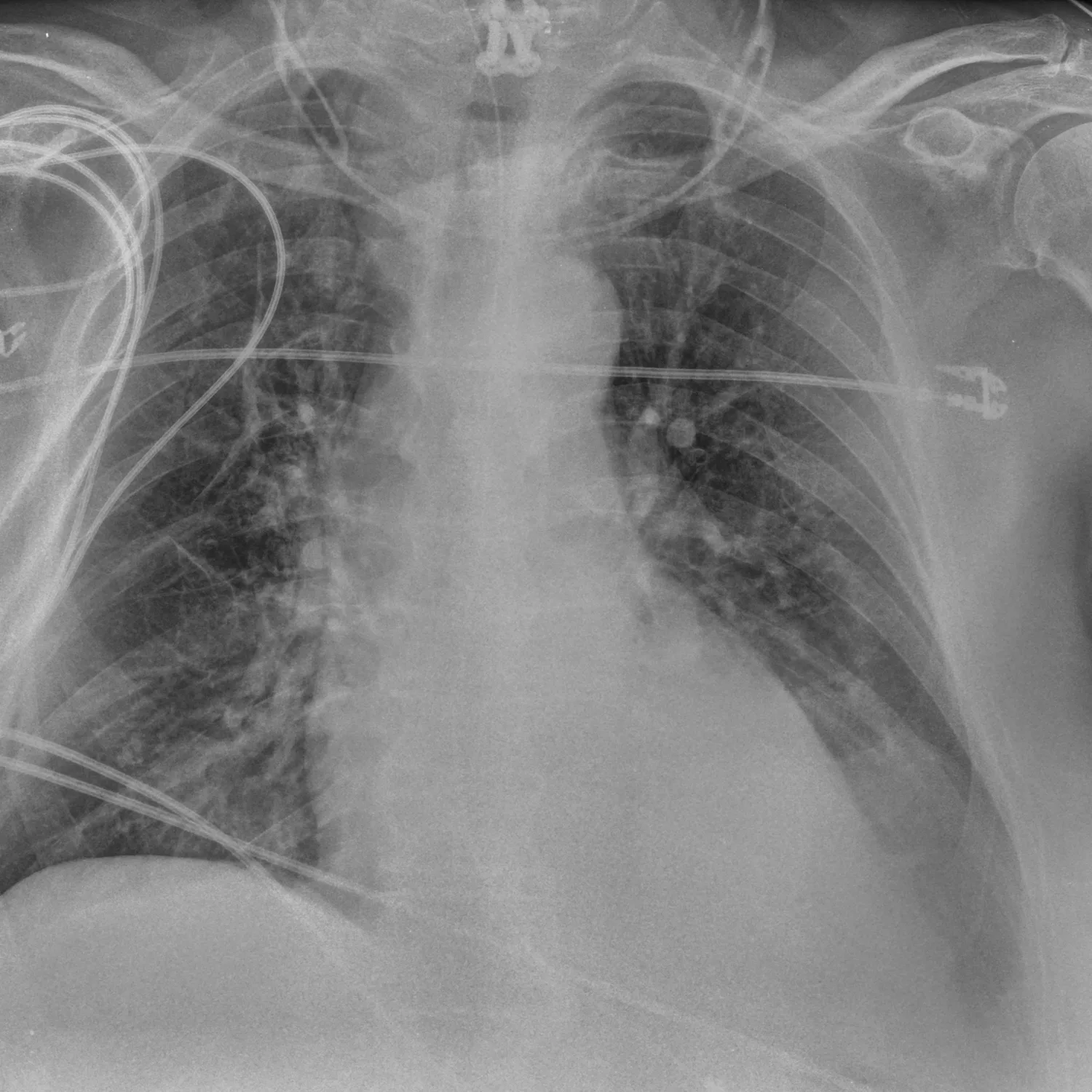 Portable chest radiograph in viral pneumonia with monitoring leads across the chest