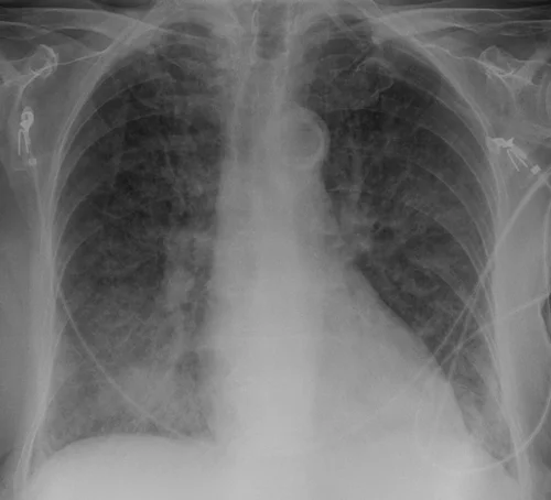 Portable chest radiograph showing interstitial pulmonary oedema with cardiomegaly and monitoring leads