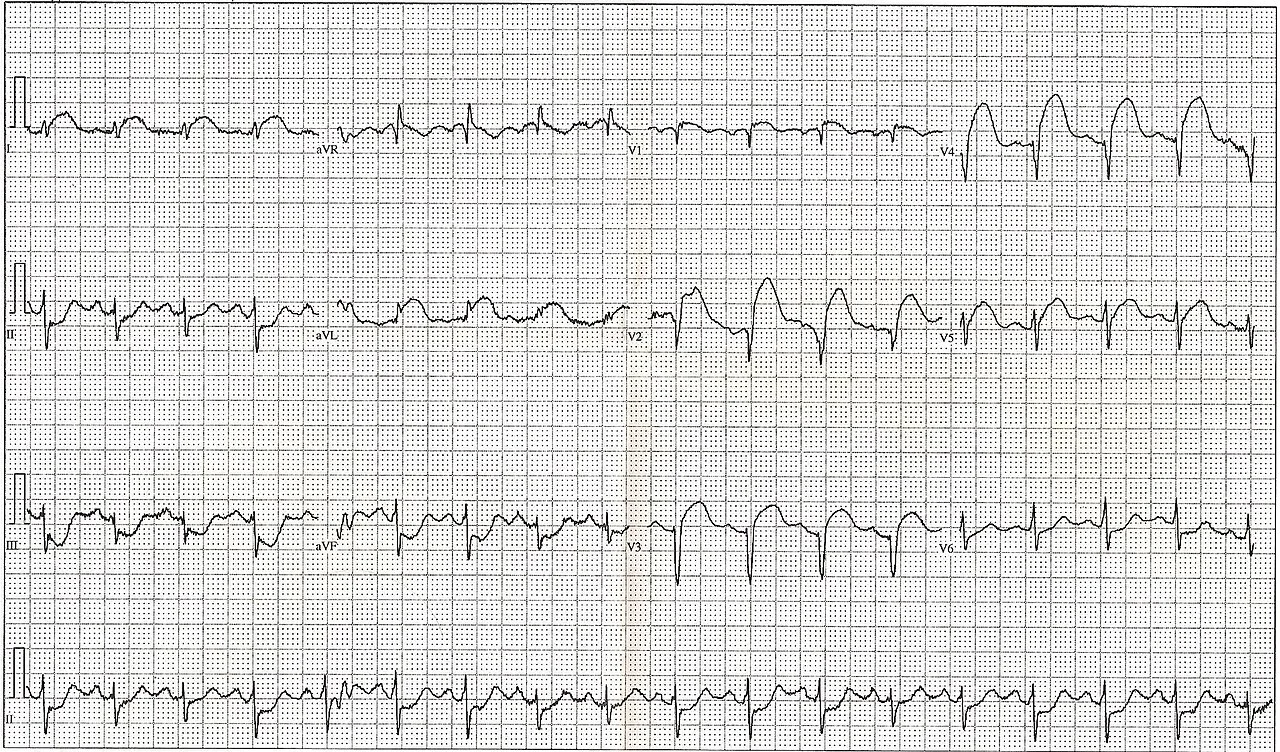 Twelve-lead ECG, unlabelled