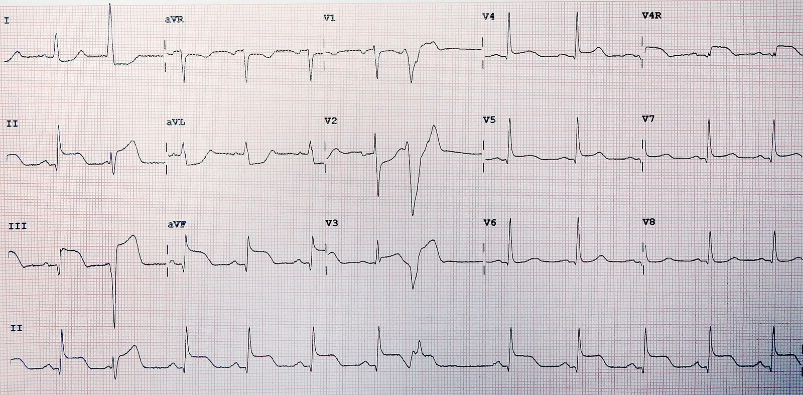 Twelve-lead ECG with posterior and right-sided leads showing inferior ST elevation with reciprocal change