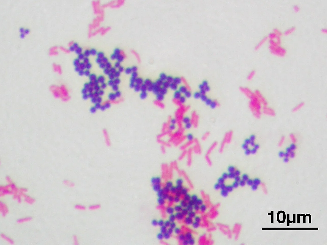 Gram stain showing purple gram positive cocci in clusters beside pink gram negative rods, with a scale bar