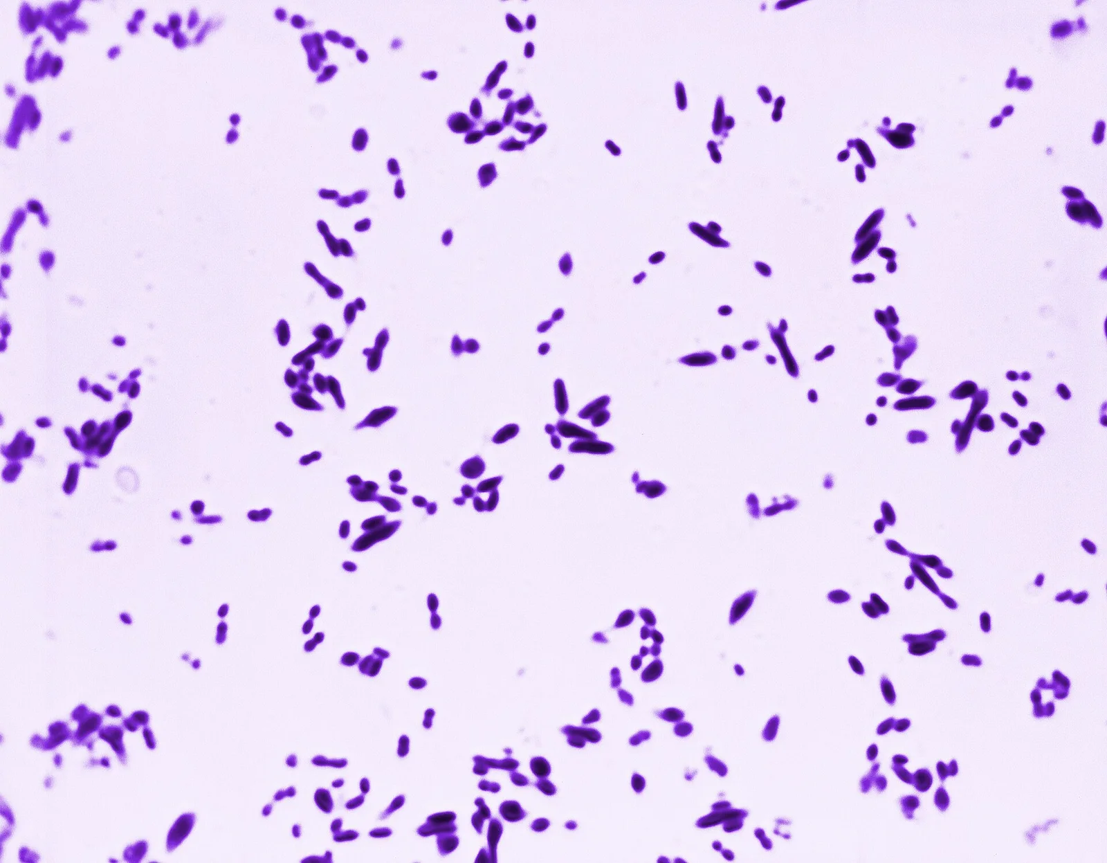 Gram stain showing gram positive lancet-shaped diplococci of Streptococcus pneumoniae