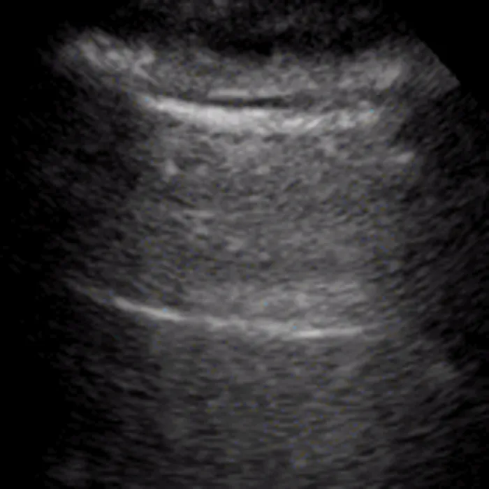 Lung ultrasound showing a normal A-line reverberation pattern