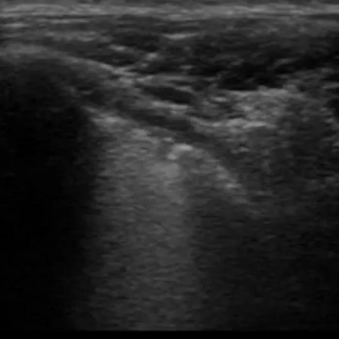 Lung ultrasound in viral pneumonia with an irregular pleural line and vertical artifacts