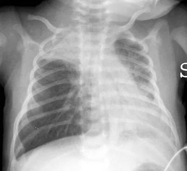 Frontal chest radiograph of an infant with bronchiolitis showing hyperinflated lungs, flattened diaphragms and patchy atelectasis
