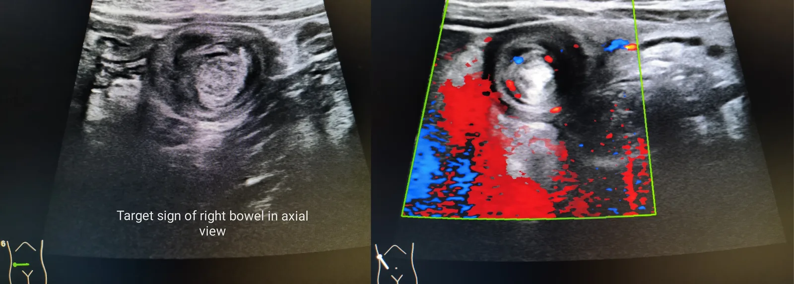 Abdominal ultrasound in axial view showing the target sign of an intussusception, with colour Doppler on the right showing minimal vascularity in the bowel wall