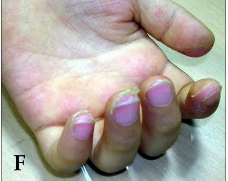A child's hand with sheet-like peeling of the skin of the fingertips, the periungual desquamation of Kawasaki disease