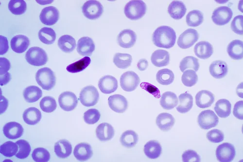 Thin blood film showing crescent-shaped Plasmodium falciparum gametocytes beside ring forms