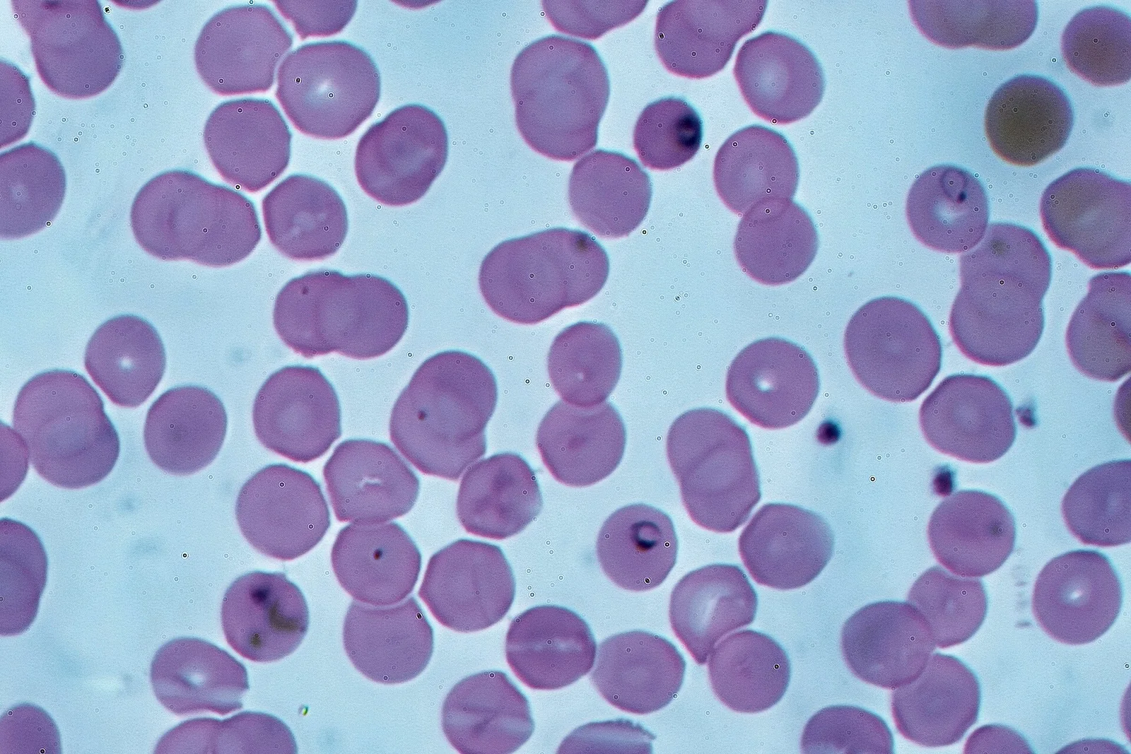Thin blood film with many Plasmodium falciparum ring forms, several red cells carrying more than one parasite