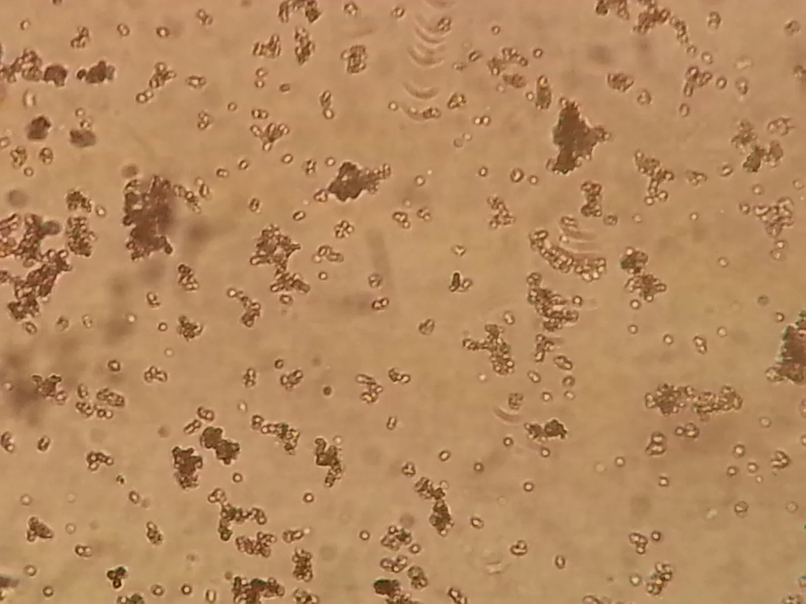 Urine microscopy showing clumps of amorphous urate crystals