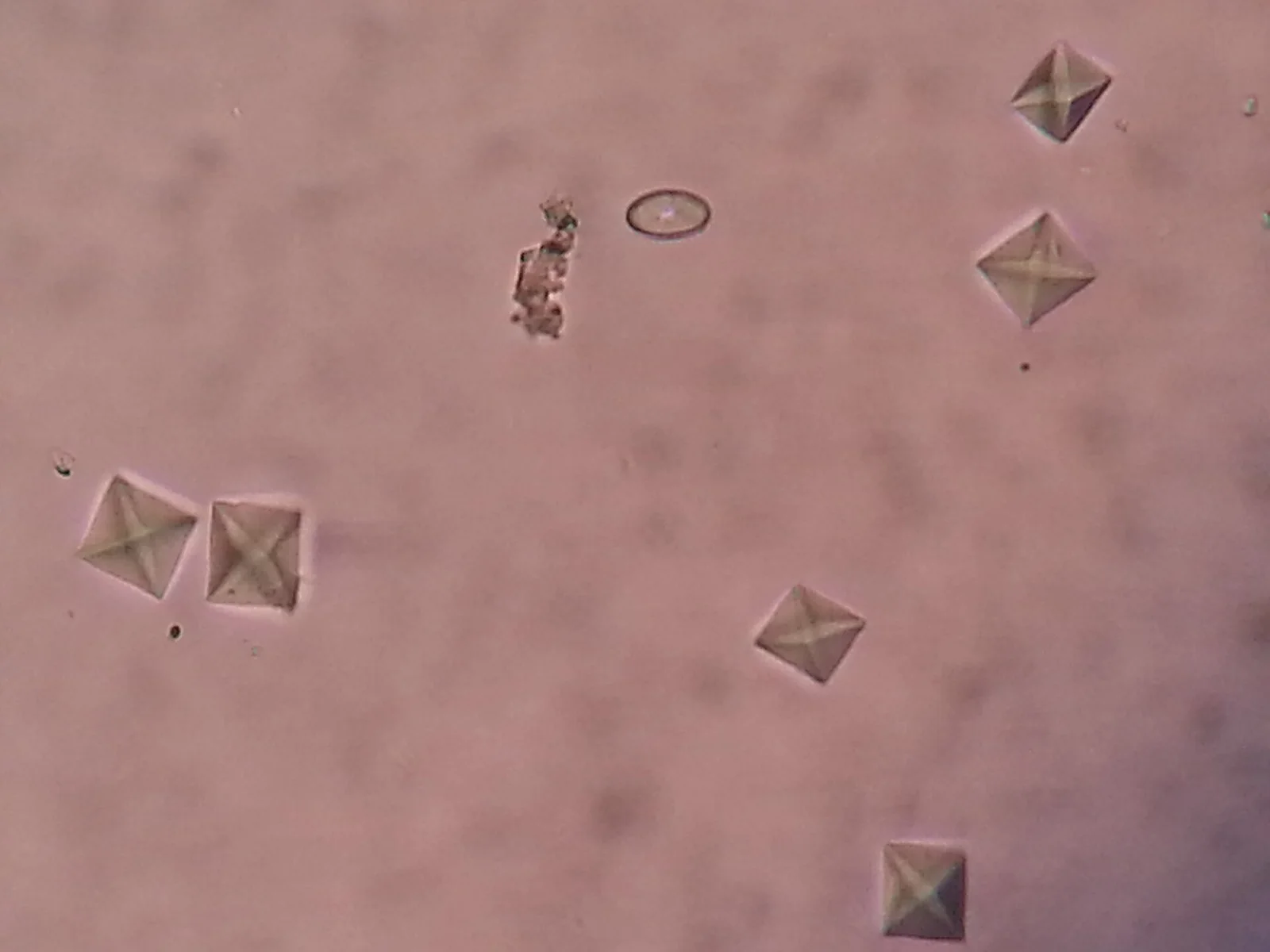 Urine microscopy showing envelope-shaped calcium oxalate dihydrate crystals