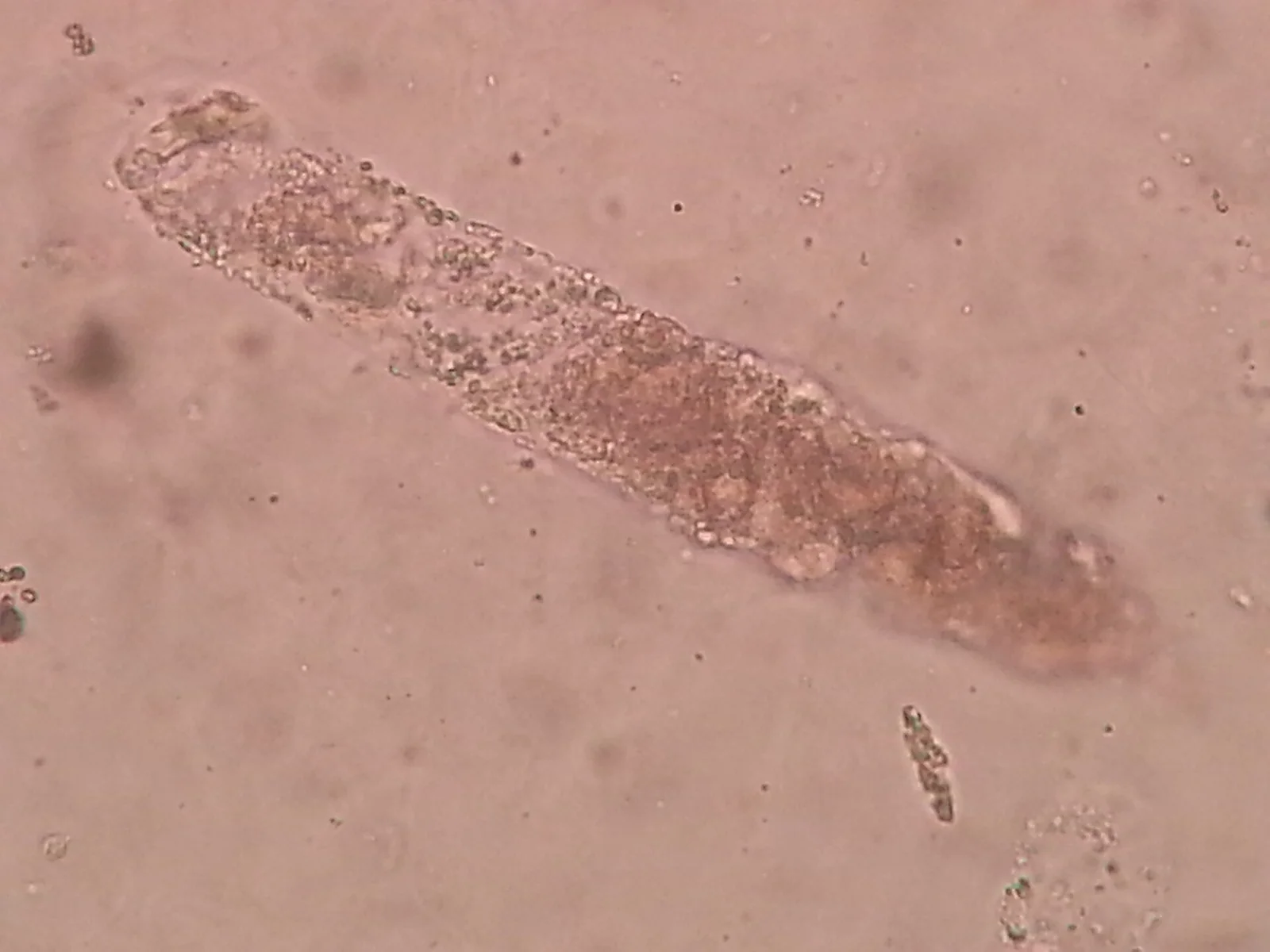 Urine microscopy showing a single coarse granular cast