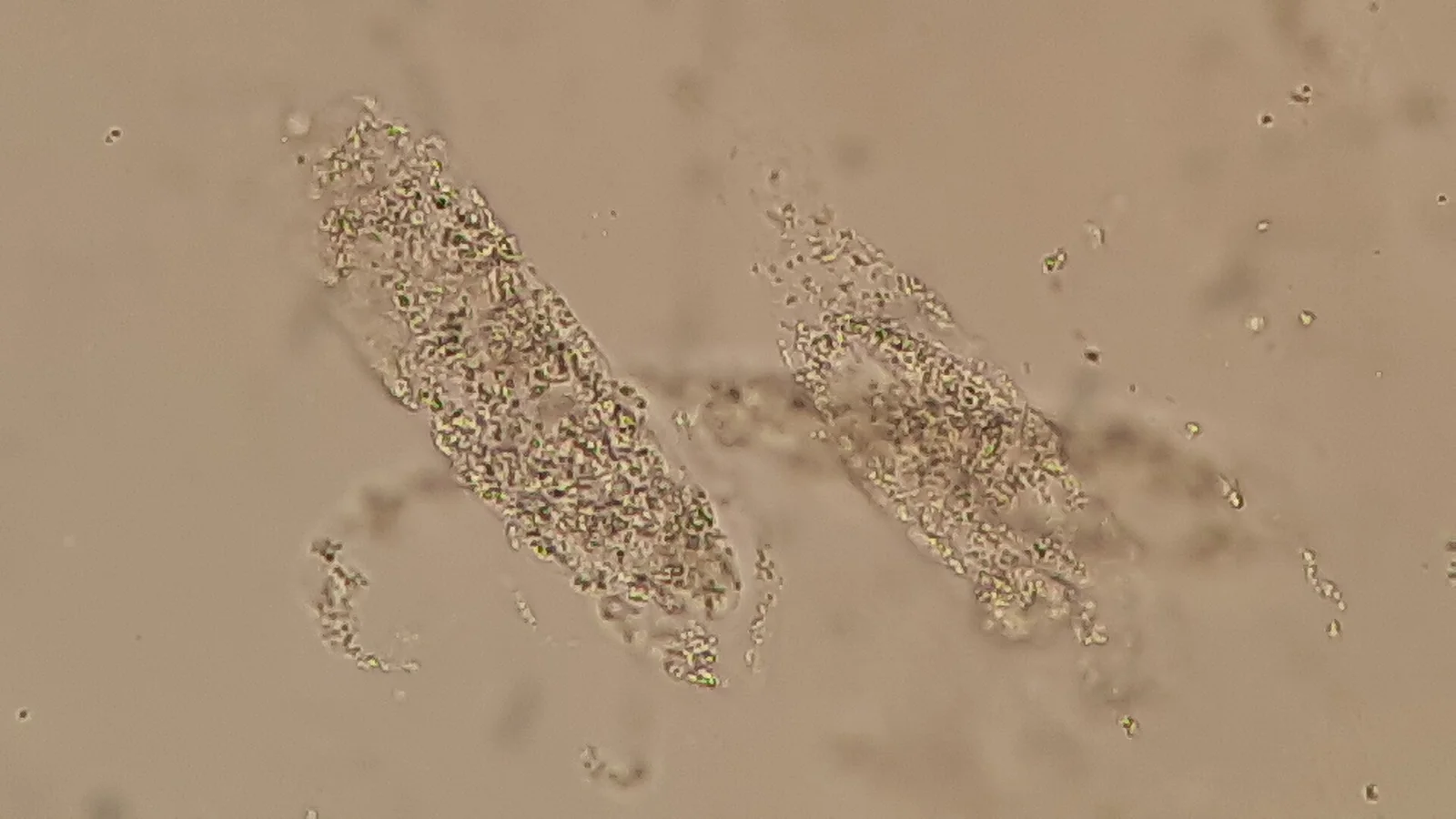 Urine microscopy showing several muddy brown granular casts