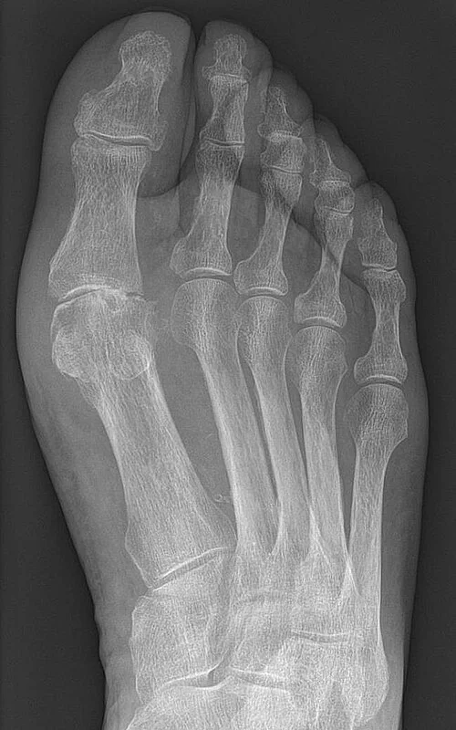 Radiograph of the foot showing juxta-articular erosions with overhanging edges at the first metatarsophalangeal joint